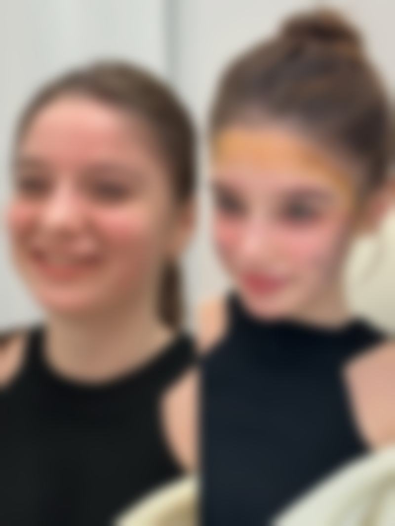 双眼皮抽脂埋线多久能完全恢复？一般1 - 3个月，恢复时间受体质和护理等因素影响！ 