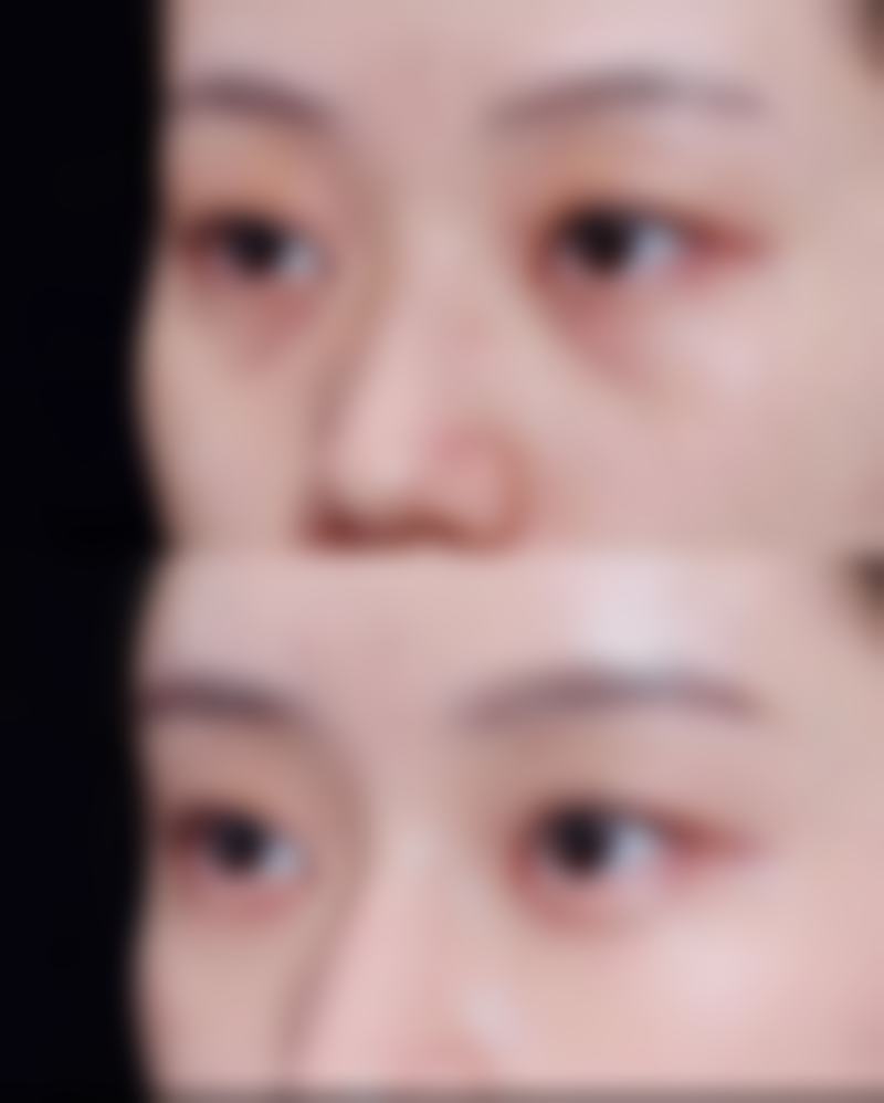 小阴唇缩小有什么危害？感染、出血等风险需警惕，手术慎选规避不良后果！ 