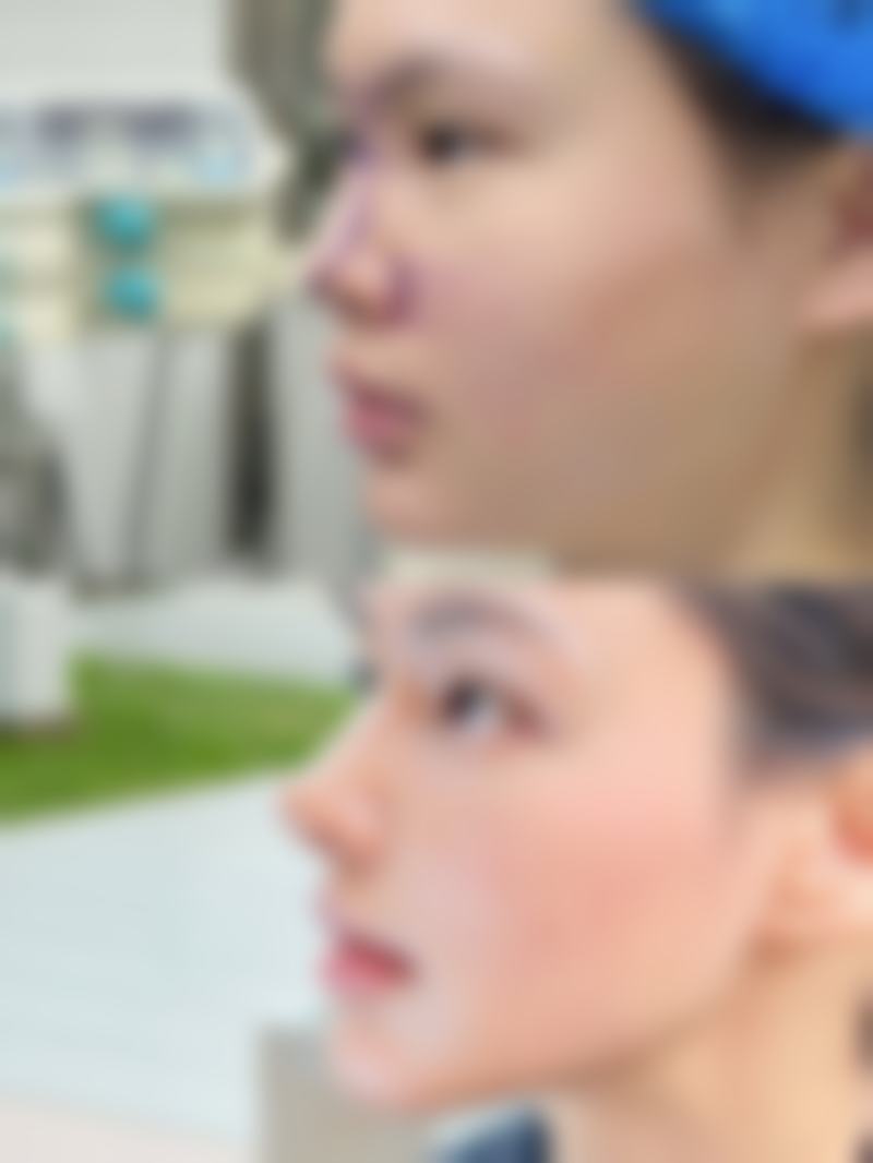 有什么办法去眼袋吗？非手术方法大揭秘