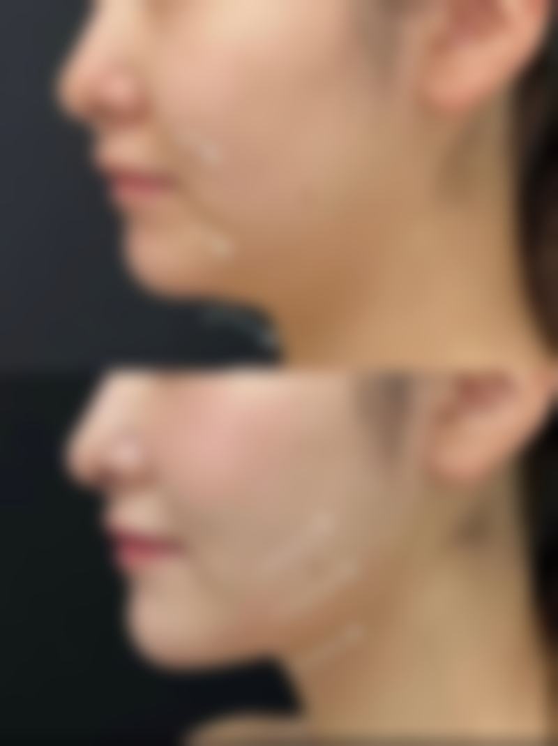 怎么样做双眼皮眼睛会变大？选择适合自己的方法