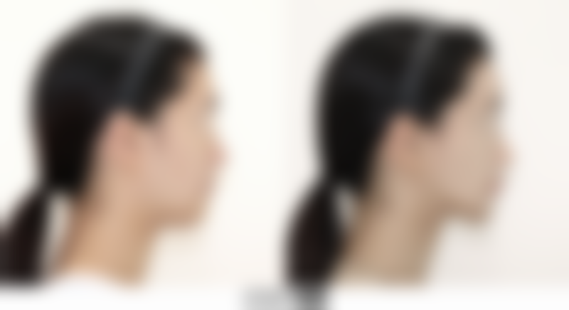 双眼皮拆线的免拆线哪个好？各有利弊，需结合个体恢复、瘢痕体质和术后护理条件来选择！ 