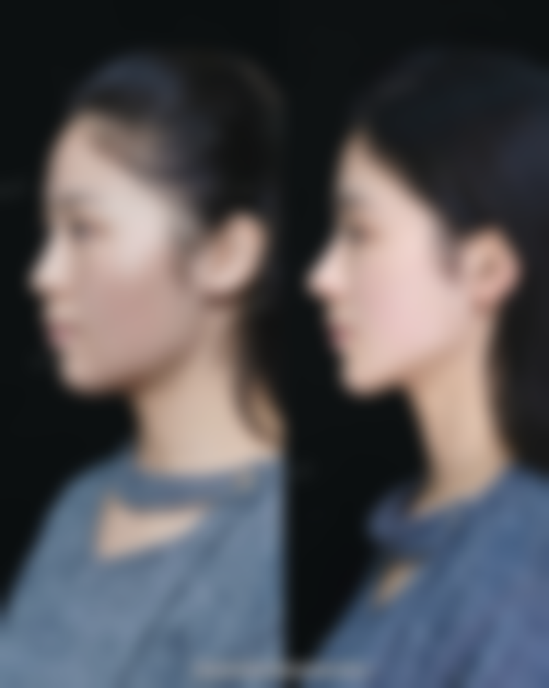 个人体质对祛痣疤痕消除时间的影响