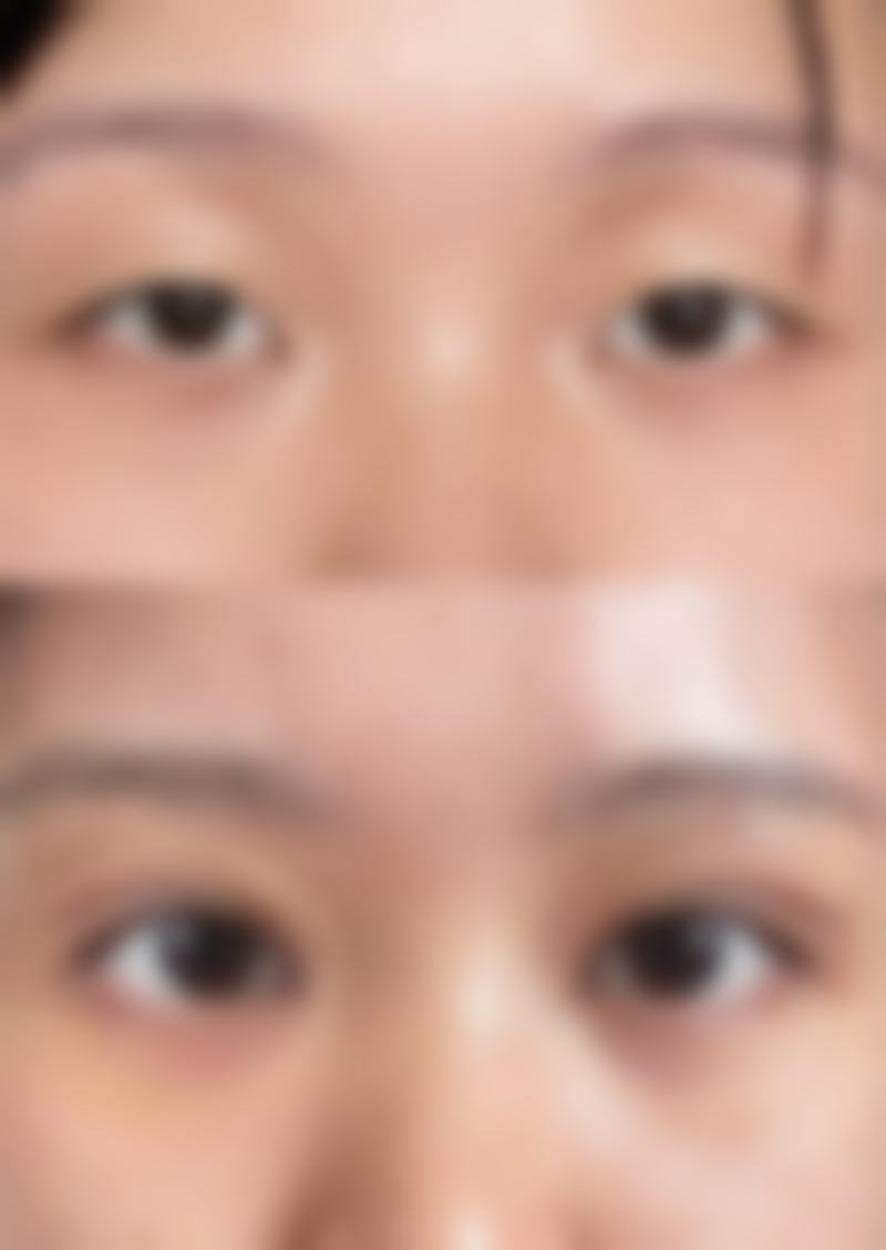 影响双眼皮修复时间的因素