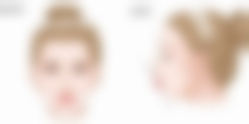 巴克祛疤膏对增生疤痕有效果吗？通常疗效有限，严重增生疤建议结合激光等治疗！ 