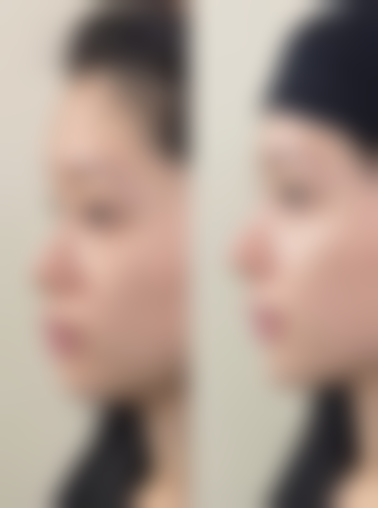 什么方式隆胸最安全？假体、自体脂肪、玻尿酸隆胸各有优劣，选适合自己的才更靠谱！ 