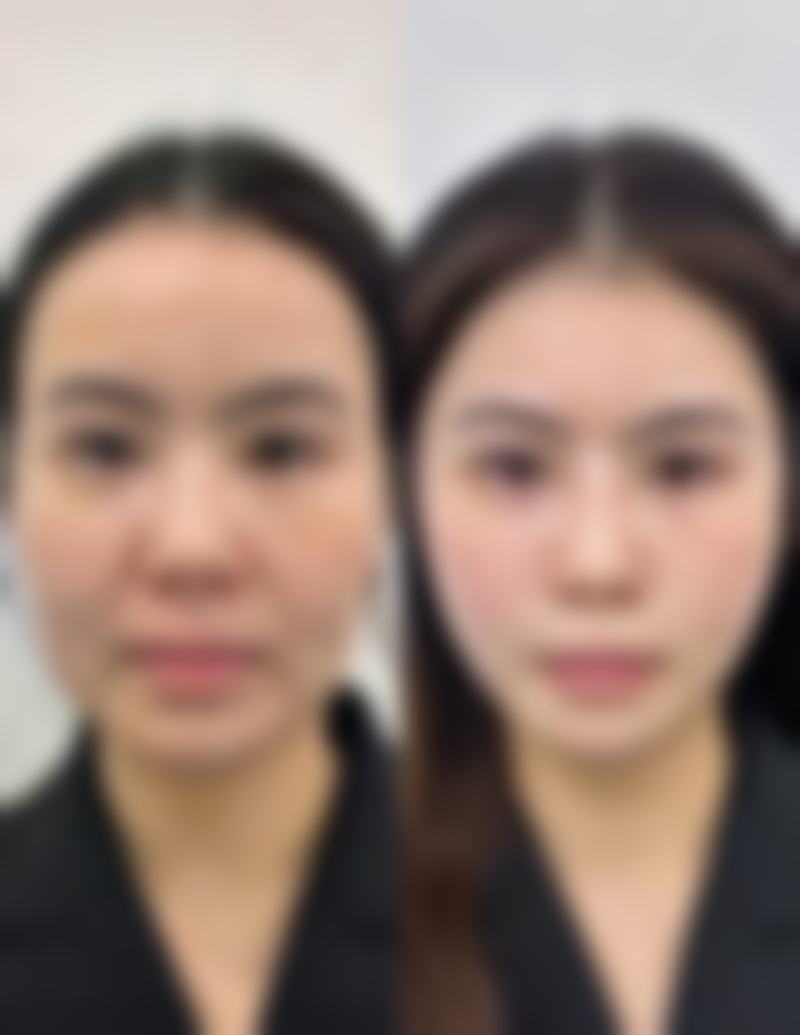 从生活习惯上预防和减轻双眼皮水肿