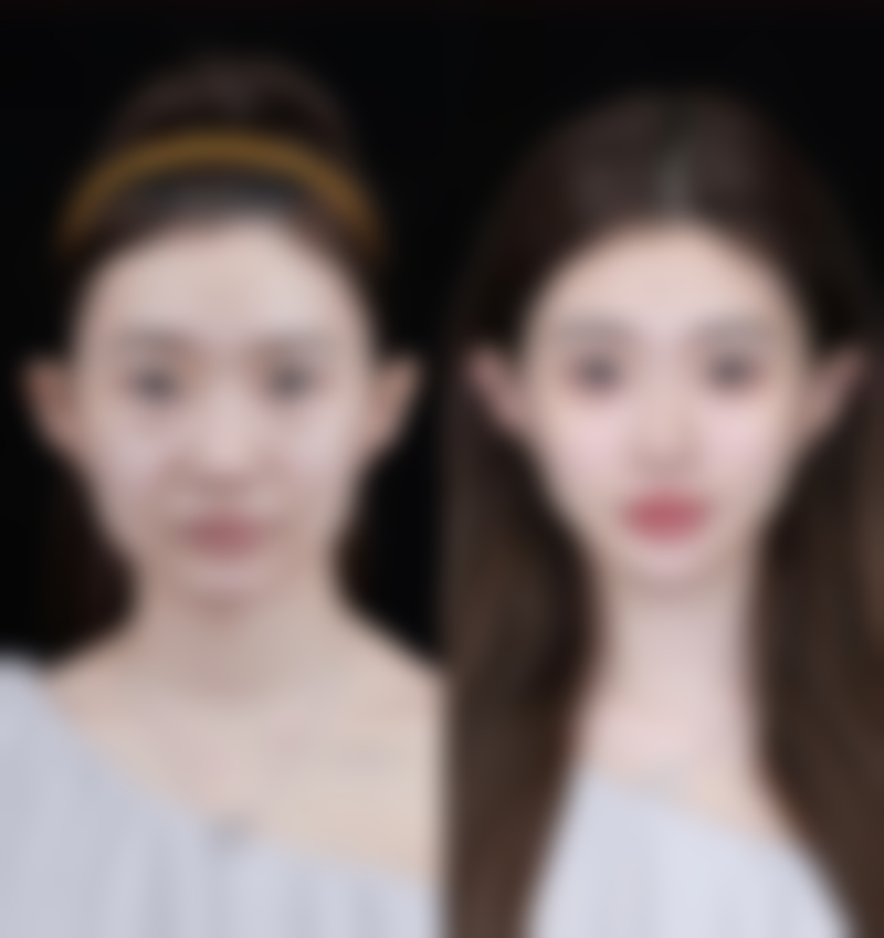 打了瘦脸针十天了怎么还没有效果？可能与体质、药物等因素有关，建议继续观察或咨询医生！ 