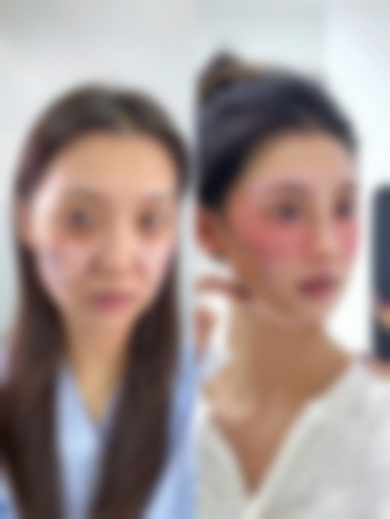 打瘦脸针多了会怎么样？可能导致面部僵硬、咀嚼无力，还会有过敏、感染等诸多不良反应！ 