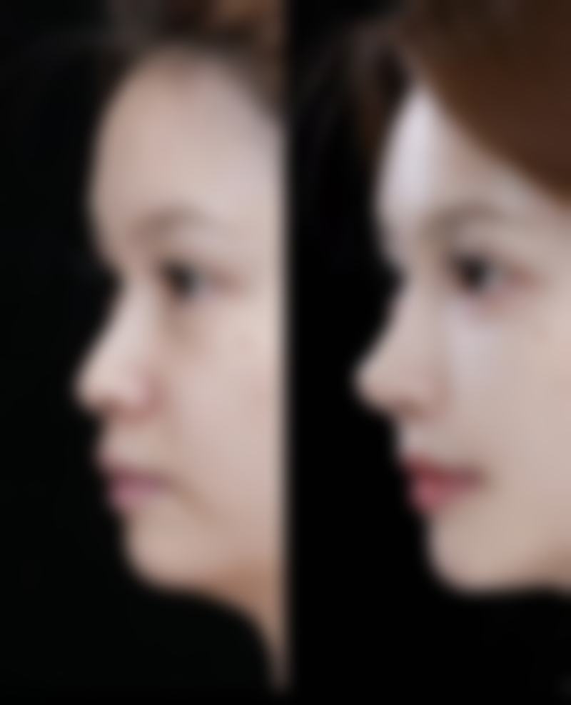 过敏导致双眼皮突然肿了