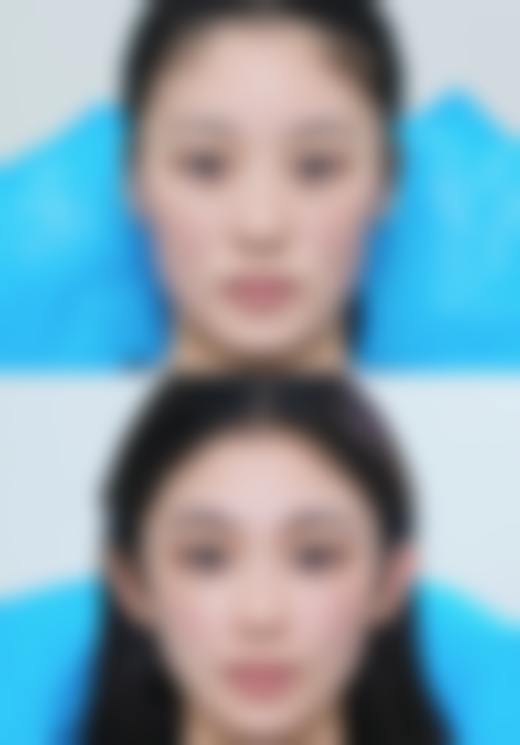 突然双眼皮肿了怎么回事？可能是生理、过敏、感染或疾病因素，久不缓解要就医！ 