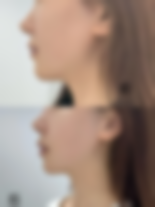 疤痕疙瘩激光治疗好吗？效果因大小、体质而异，选正规医院并结合多法治疗更可靠！ 