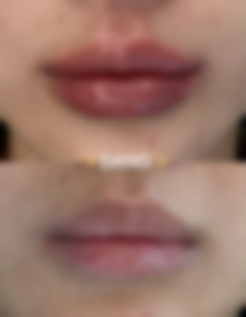 疾病因素导致双眼皮突然肿了