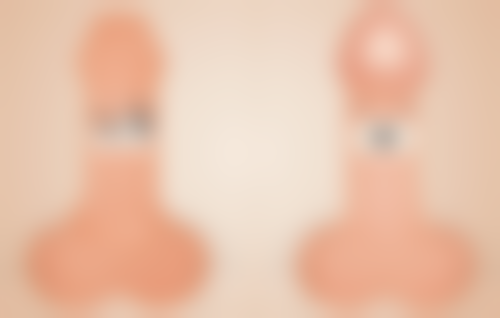 手术治疗完全消除疤痕疙瘩