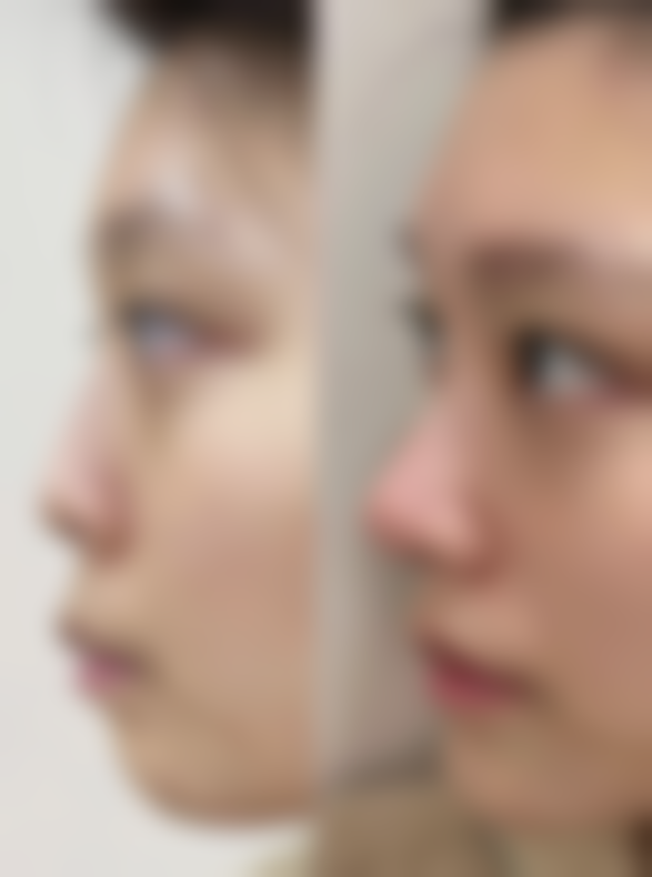 大蒜汁能去眼袋吗？实际应用中的成效及风险