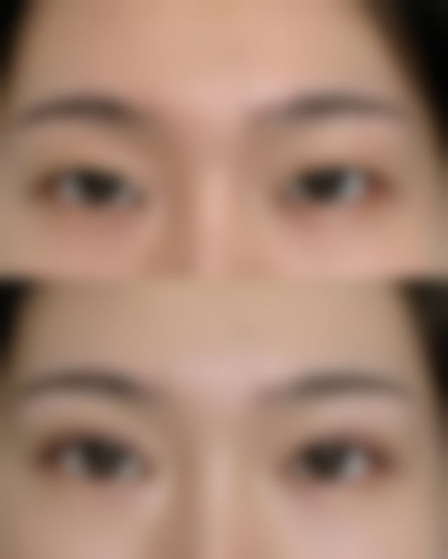 激光治疗擦伤疤痕