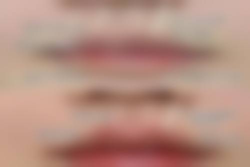 五、广州瑞美医疗美容谭泳昌医生技术怎么样?