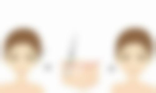 男士隆鼻之手术风险考量