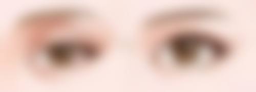 光纤溶脂去眼袋的成效分析