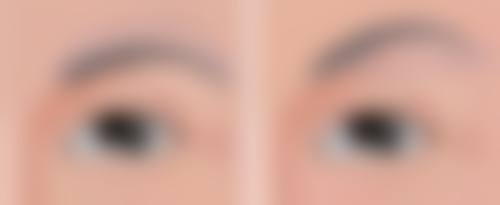 自软骨隆鼻是永久性的吗？一般来说存活后可永久存在，但有吸收风险，术后也需注意保护！ 