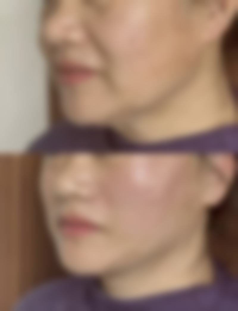 做隆胸手术是永久的吗？答案并非绝对，效果受方式、护理、体质等多因素影响！ 