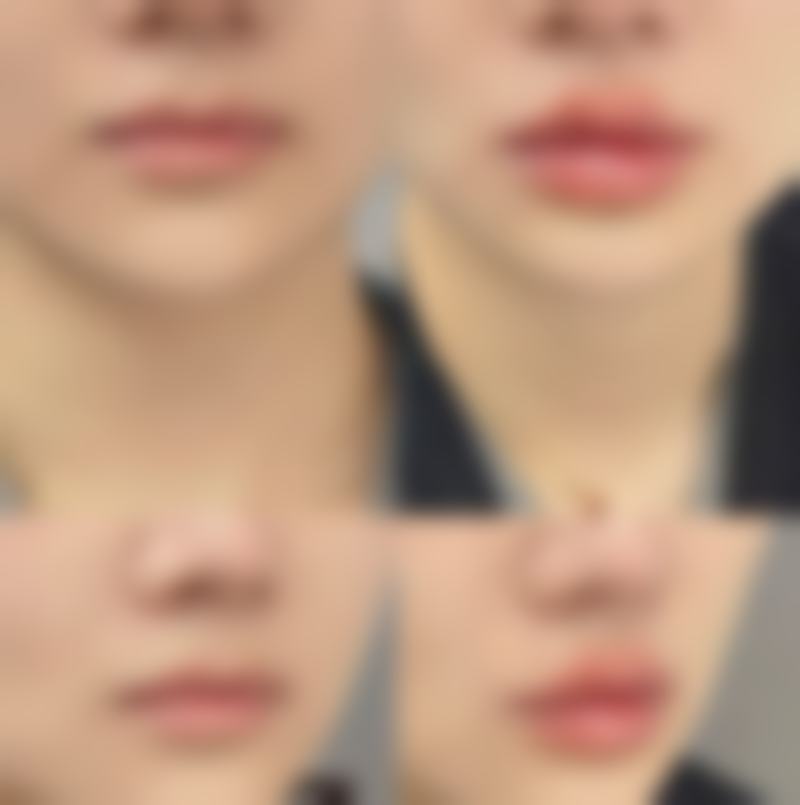 自软骨隆鼻后软骨的存活情况