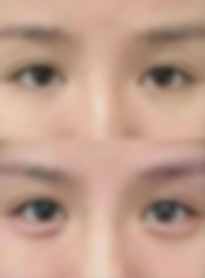 韩国me双眼皮的缺点