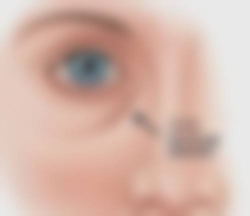 种植头发之瘢痕问题