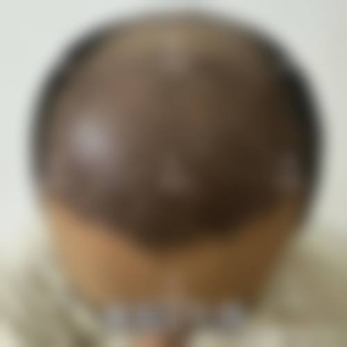 五、北京大麦植发医院(原科发源)收费价格表