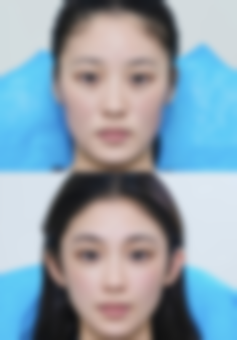 长痘痘留的疤痕怎么去除？科学护理不可少