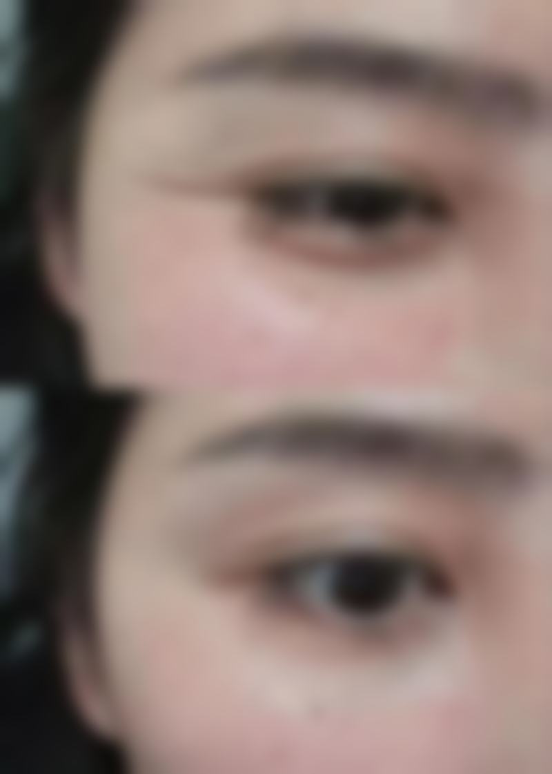 怎么就可以去眼袋？手术治疗见成效