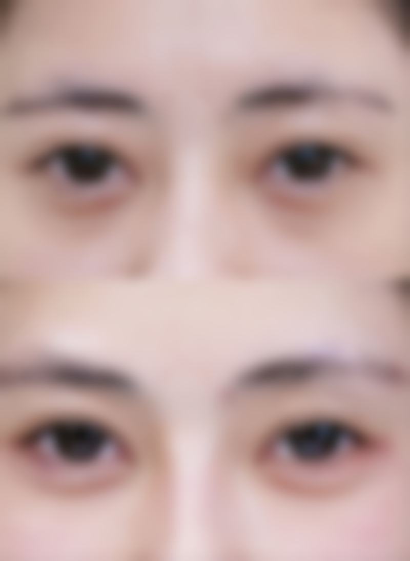 术后多久用疤痕贴？一般切口愈合1 - 2周可用，不同手术、部位及个人情况有差异！ 