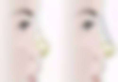 六、长沙艾美尔医疗美容李烈梧医生口碑评价及真人实例反馈