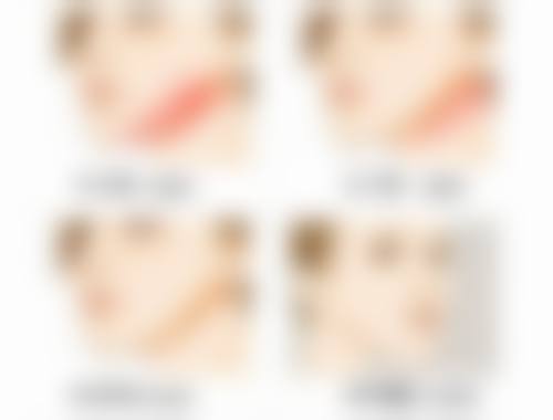 隆胸后多久可以取出假体？一般建议术后至少等6个月，取出时间还受材质等因素影响！ 