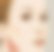 线提升隆鼻为什么会因自身组织反应顶线？