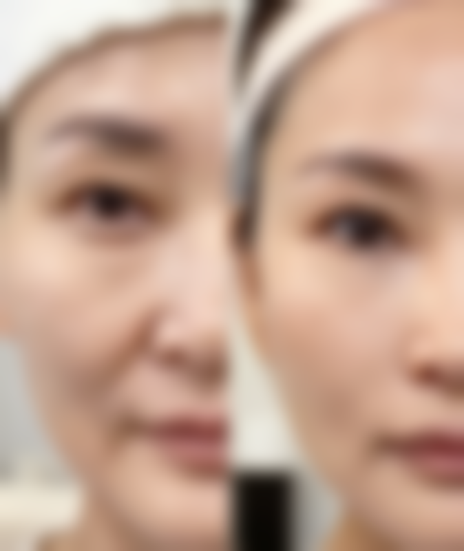 改善眼袋的综合方法