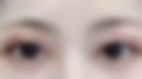 什么去除眼袋效果最好？手术、非手术、日常护理各有千秋，按需选择才是王道！ 