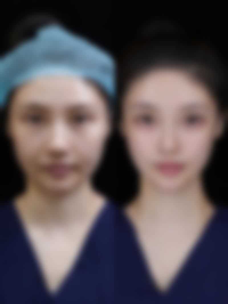 双眼皮拆线后会肿吗？通常还是会肿，消肿时间受手术方式等多因素影响，护理很关键！ 