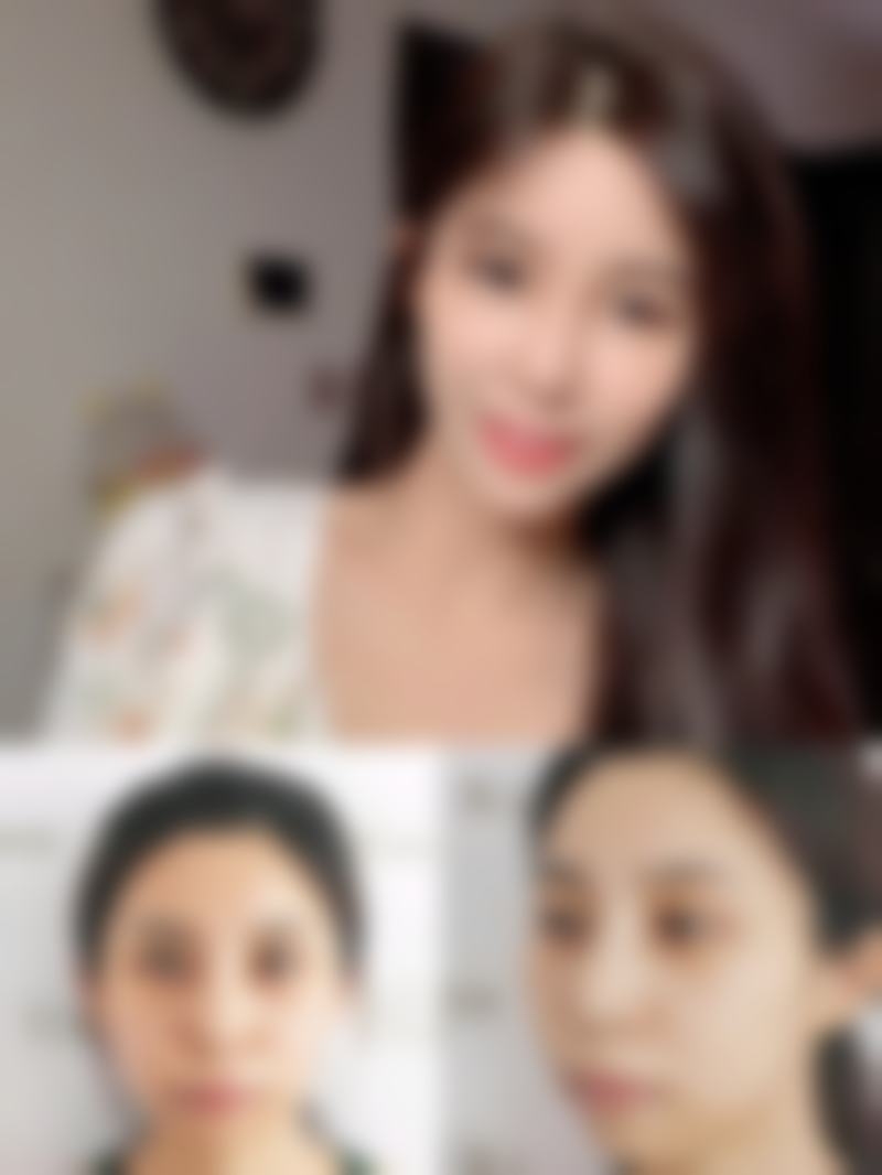 割双眼皮了能喝咖啡吗？术后各阶段和个体情况不同，饮用建议有别，快来了解一下！ 