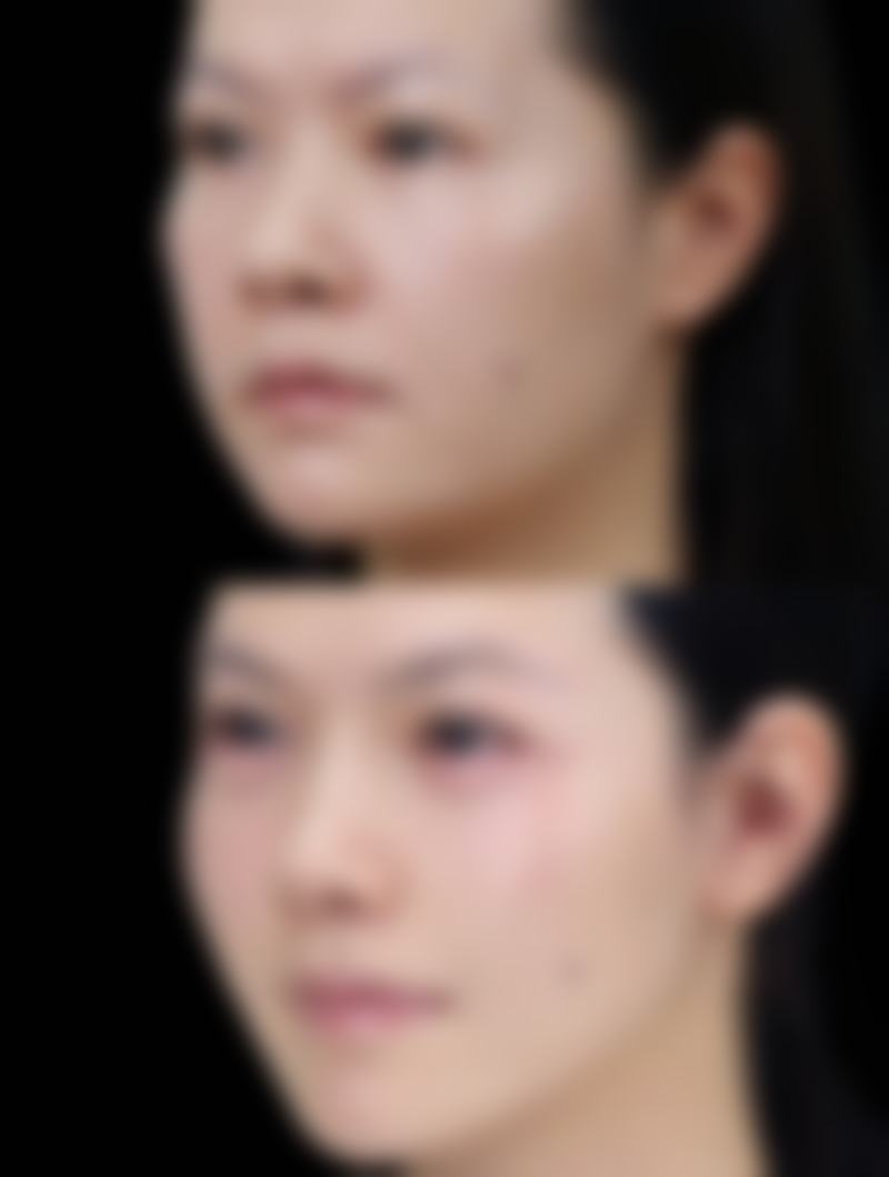 激光治疗：精细打击增生疤痕