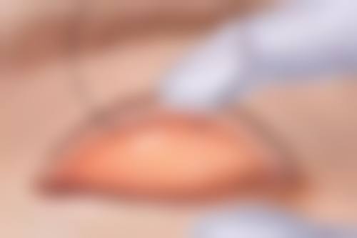 有疤痕增生怎么消除好？压力治疗不可少