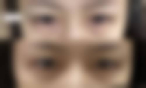 五、上海大麦微针植发黄志春医生技术怎么样?