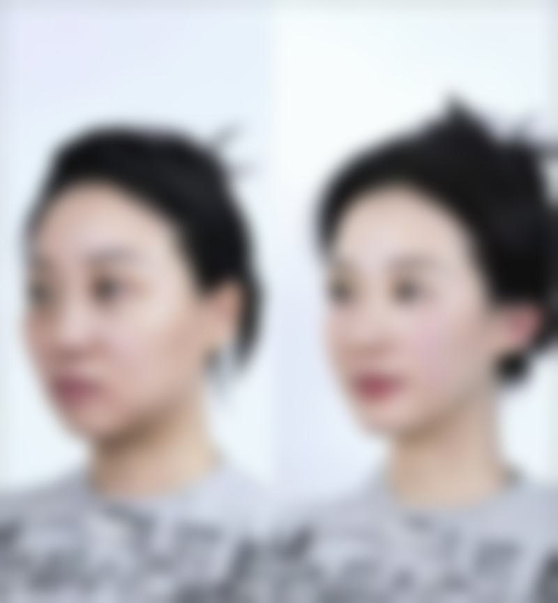 有疤痕增生怎么消除好？涂抹药膏是基础选择