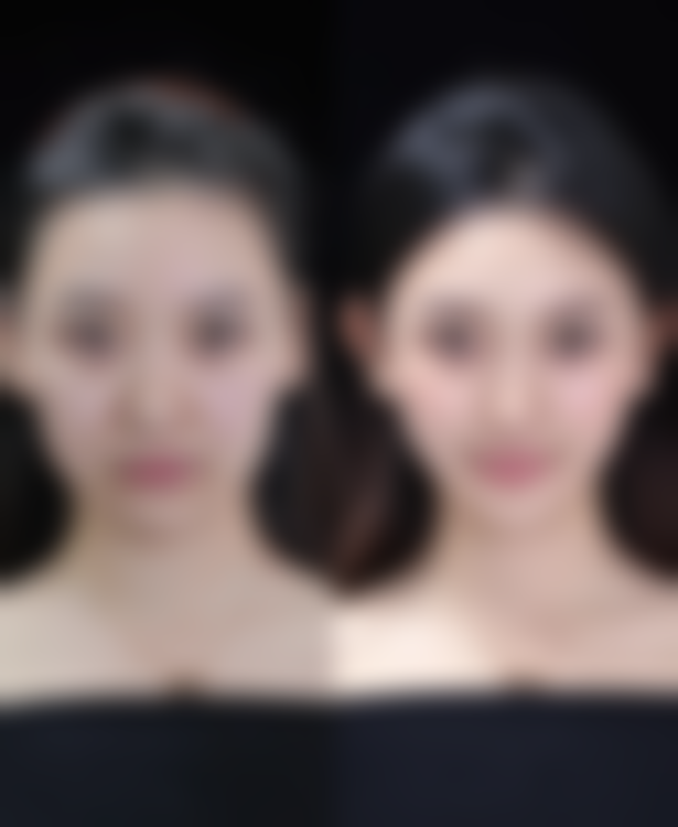 六、郑州惠美医疗美容谢峰医生口碑评价及真人实例反馈