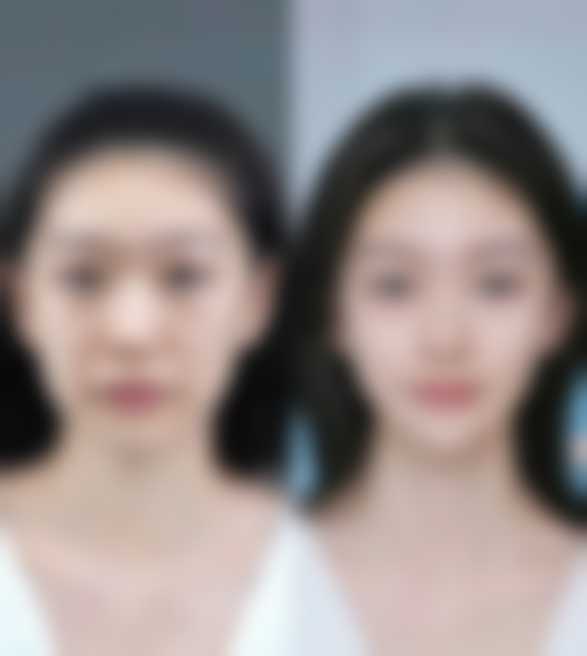 打完瘦脸针两边脸不对称怎么办？可自然恢复、补充注射或修复治疗，操作需遵专业建议！ 