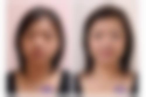 面部除皱用什么针？玻尿酸、肉毒素、胶原蛋白、自体脂肪针各有千秋，按需选择！ 