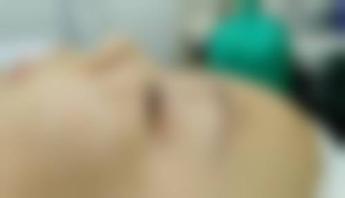 双眼皮28天了还肿正常吗？分情况来看，部分正常，若有感染等异常则需及时就医！ 