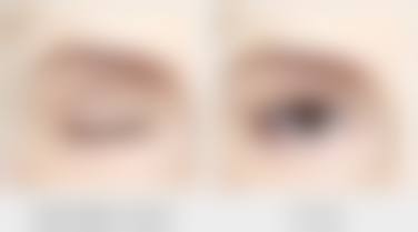 六、上海大麦微针植发付华刚医生口碑评价及真人实例反馈