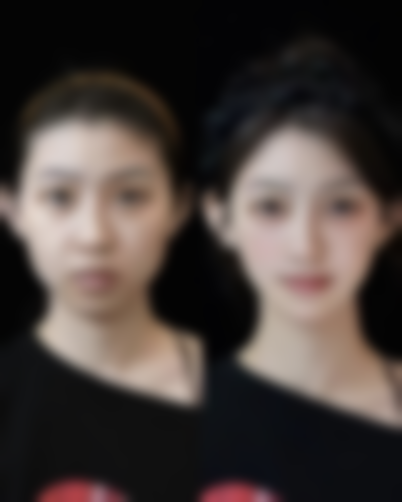 六、泰国清迈lannawadee兰纳瓦德整形TeerasakPhadayakul医生口碑评价及真人实例反馈