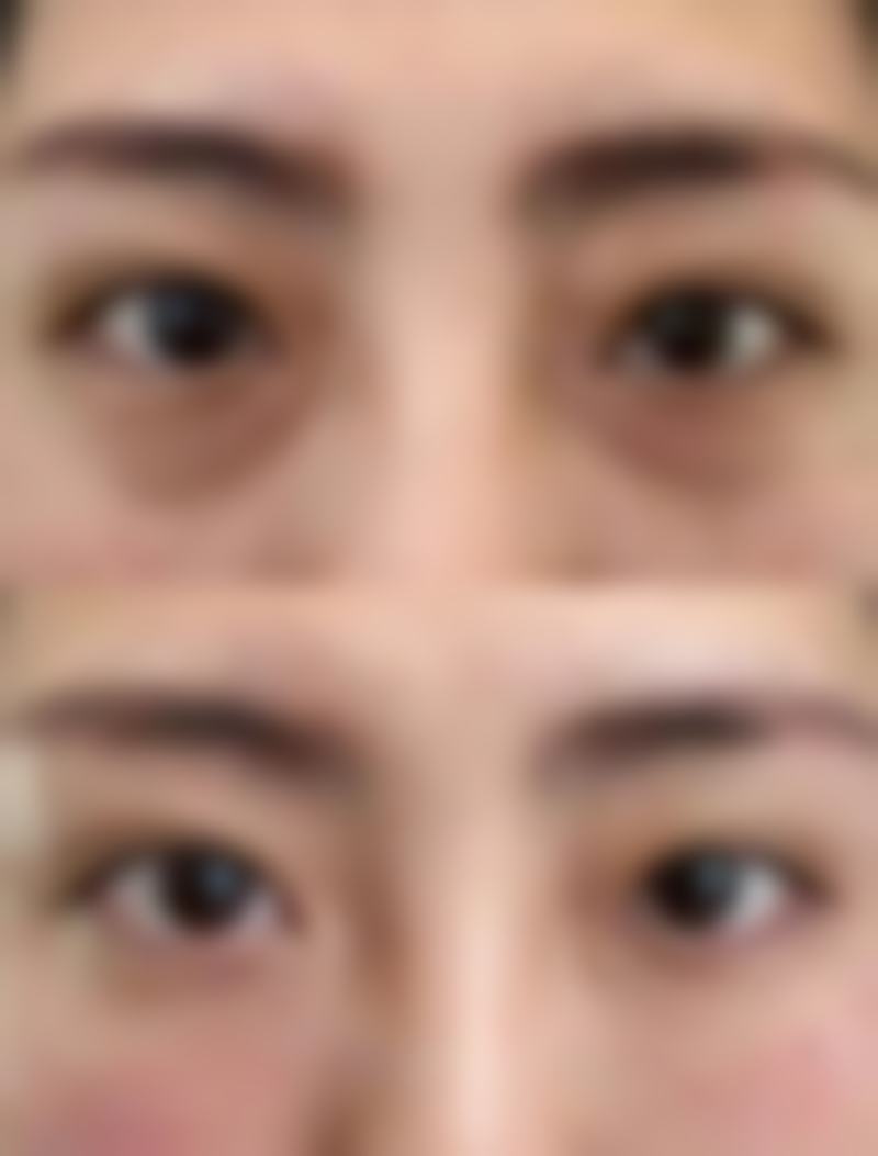 当兵疤痕体质能走吗?疤痕具体情况分析