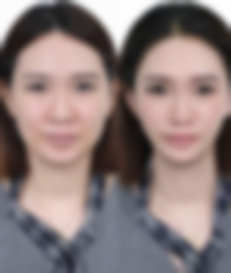 五、上海大麦微针植发付华刚医生技术怎么样?